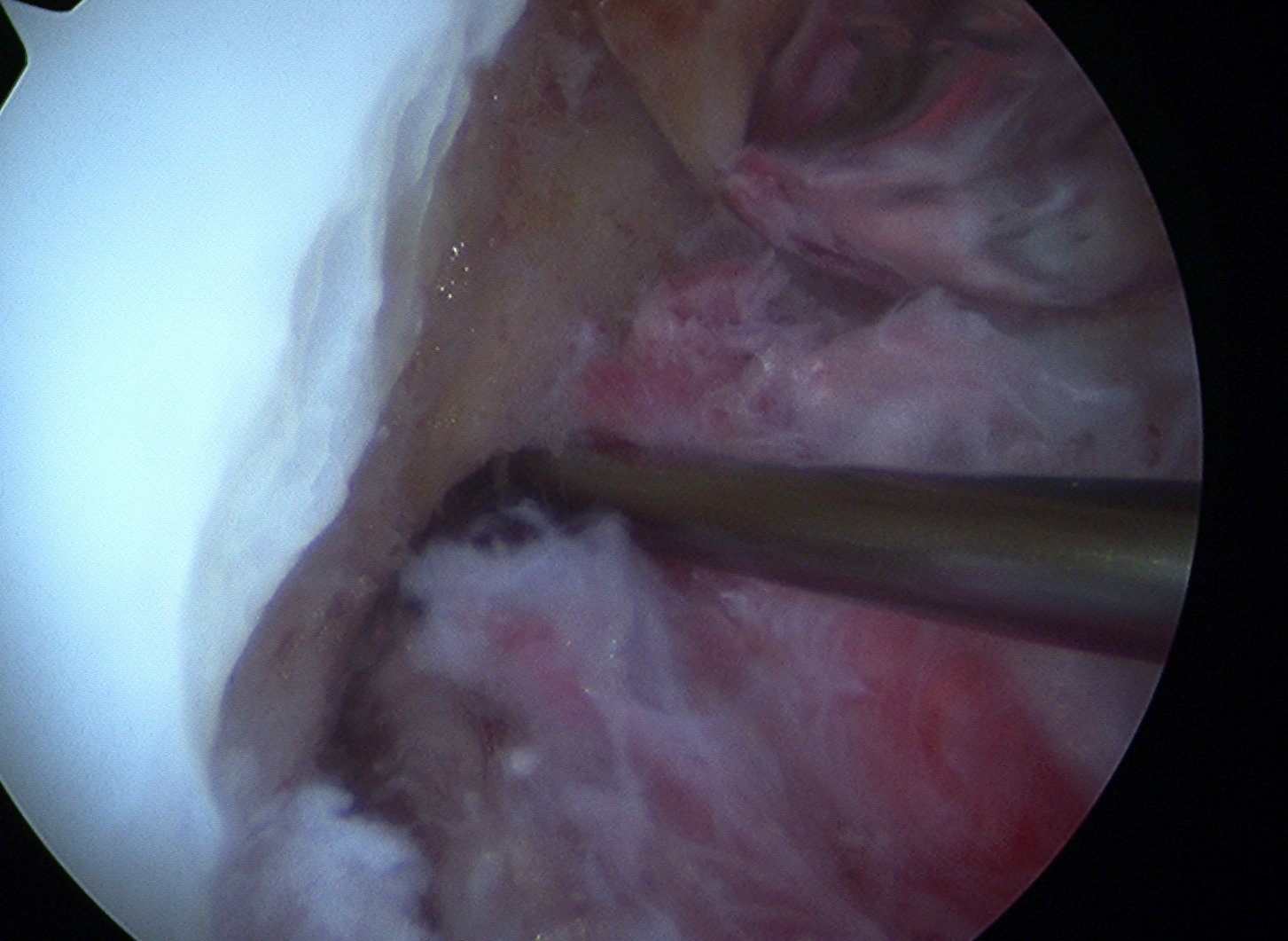 ACl Femoral Screw Guide Wire